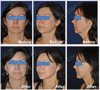 Facelift Surgery in Thailand