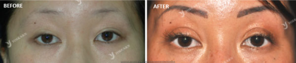 Eyelash Transplant