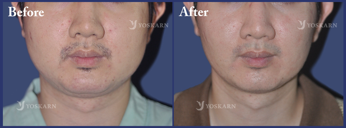 Buccal Fat Removal