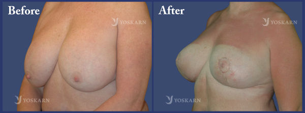 Breast Lift