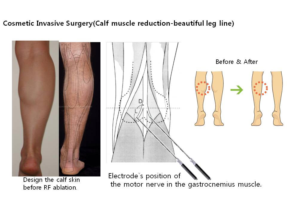 Calf Surgery
