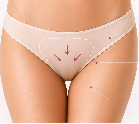 Combined Vaginoplasty