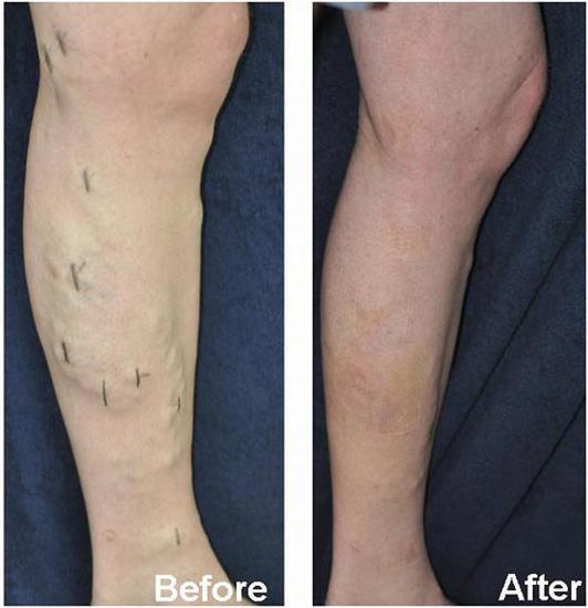 Mini Vein Surgery