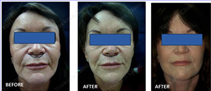 Advanced IPL Skin Rejuvenation