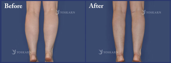 Calf Reduction by Injection