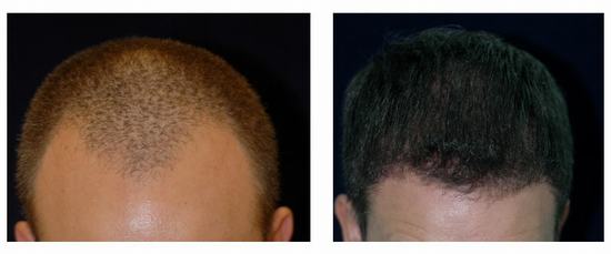 Stem Cell Therapy for Hair Restoration