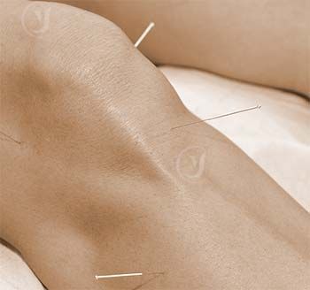 Acupuncture for Rheumatoid Arthritis