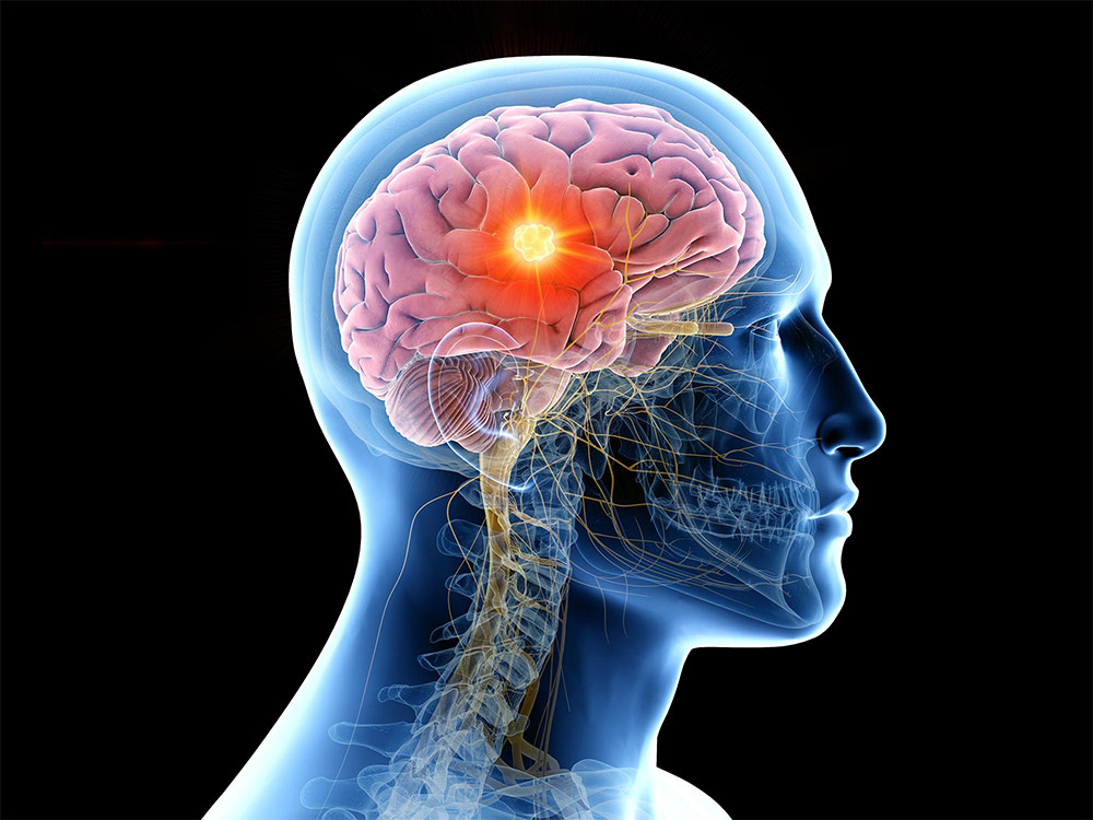 Stem Cell Therapy for Brain Injury