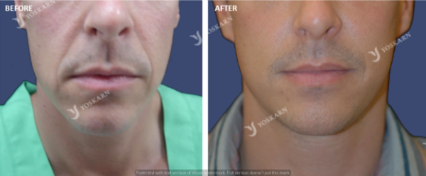 minifacelift.png