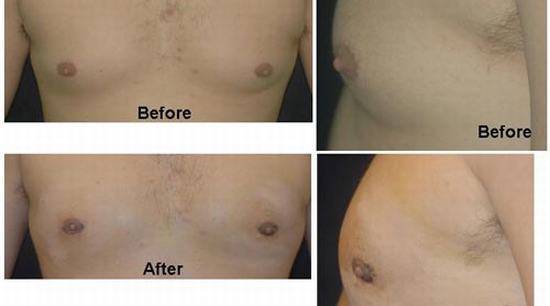 man-Breast-reduction-2.jpg