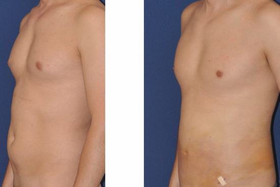 Liposuction3.jpg