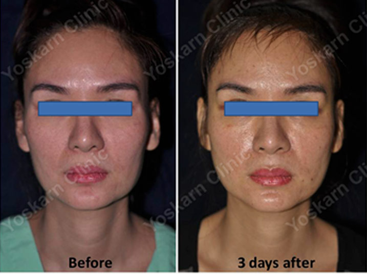 Fat Transfer
