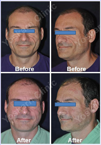 Fat Transfer
