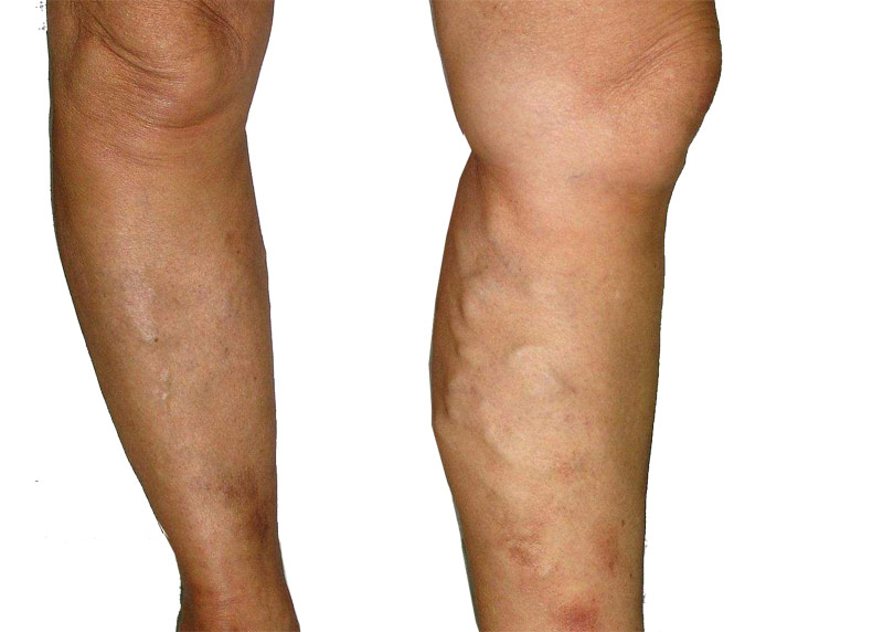 Mini-Vein-Surgery2.jpg