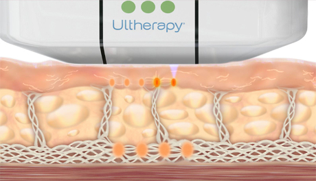 Animation-of-How-Ultherapy.jpg