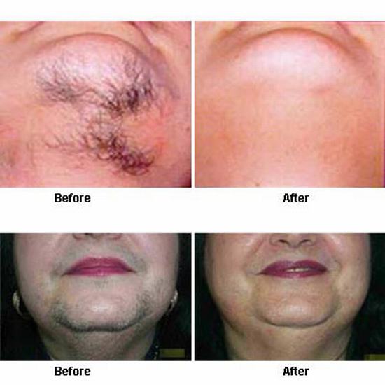 Before-After-Laser-Hair-Removal.jpg